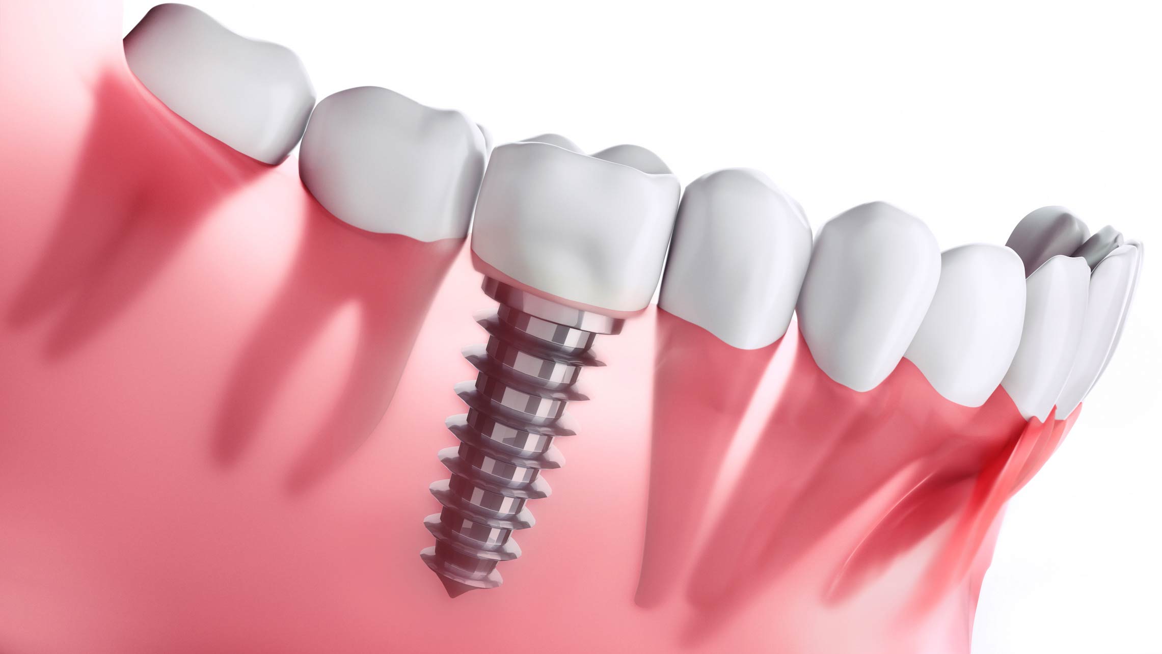 Dental Implants Procedure Explained - District Dentistry Charlotte Dental Implants Procedure Explained - District Dentistry Charlotte